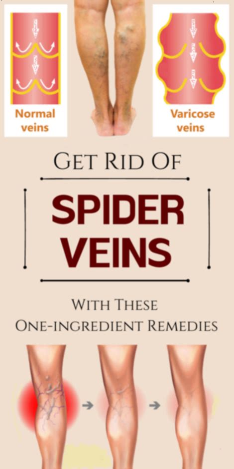 These Amazing One Ingredient Remedies Will Help You Get Rid Of Spider Veins Spider Veins Get
