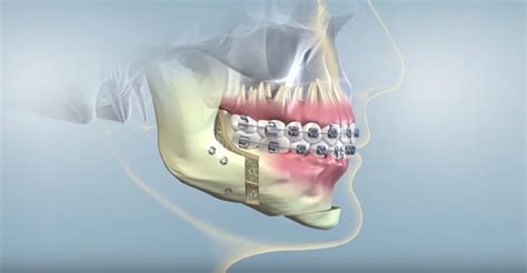 Jaw Surgery Birmingham Corrective Jaw Surgery In Hoover And Pell City