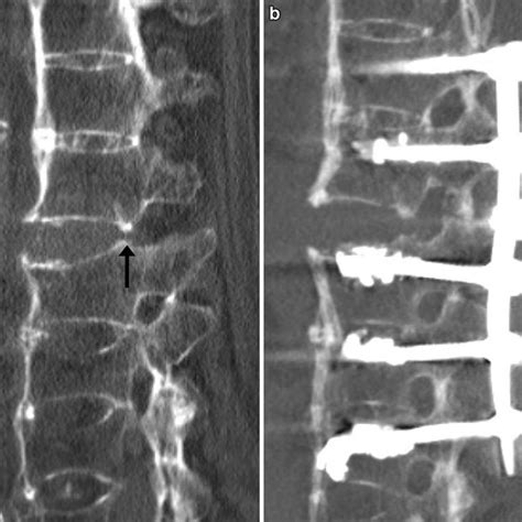 79 Year Old Male Hyperextension Injury Of Th12 Above A Pre Existing