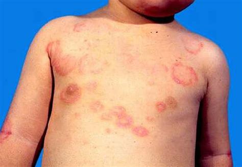 Erythema Marginatum What Is It Causes Signs Symptoms Diagnosis My XXX