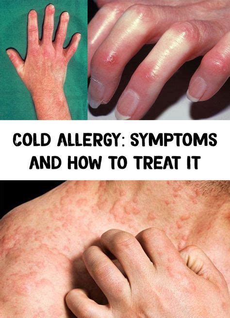 Cold Allergy Symptoms And How To Treat It Terveys