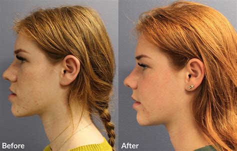 Tmj Surgery Before And After Core Plastic Surgery