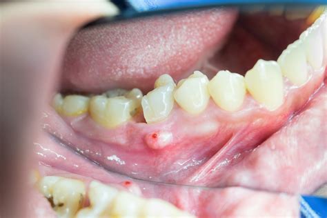 Answers To Faqs About Abscessed Teeth By Springfield Dentists