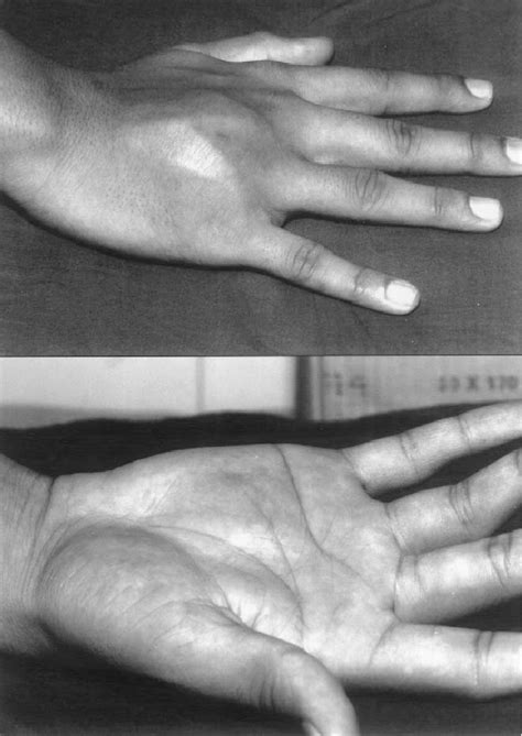 Clinical Presentation With A Swelling Over The Ring Finger Metacarpal