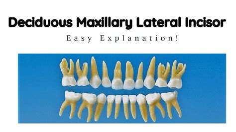 Deciduous Maxillary Lateral Incisors Primary Maxillary Lateral
