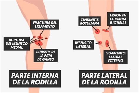 dolor de rodilla 11 causas y cómo quitar 2022