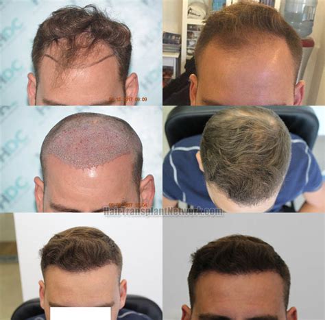 Dr Kyriakos Maras Hair Transplant Procedure Before And After Result
