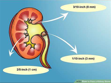 3 Ways To Pass A Kidney Stone Wikihow