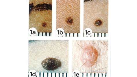Raised Brown Spots Pictures Photos