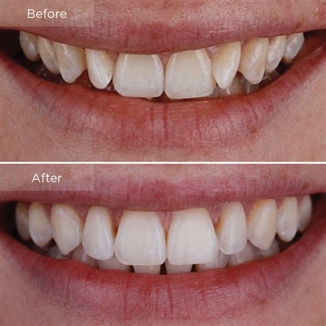 Invisalign Before And After The Dental Room