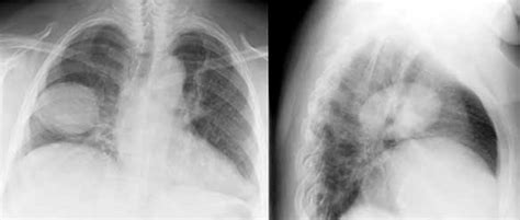 Die häufigkeit des auftretens der hamsterlunge beträgt 0,25% bis 0,4%. Sammlung Radiologie der Lungentumoren