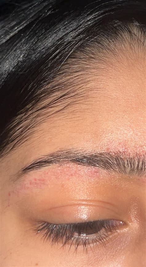 Please Help Little Dry Bumps Under Eyebrows Rdermatologyquestions
