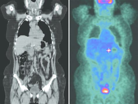 1 8 F Fdg Petct Scan Showing Uptake Near The Stomach Remnant 18 Months