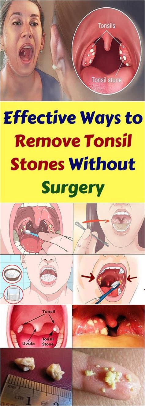 Let Start Slim Today Effective Ways To Remove Tonsil Stones Without