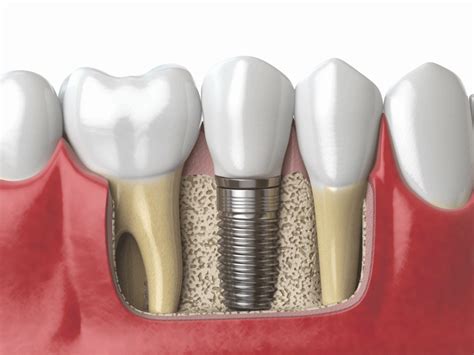 Best Dental Implants In Burnaby Burnaby Square Dental