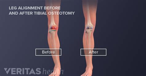 Knock Kneed Or Bow Legged Realignment By Osteotomy