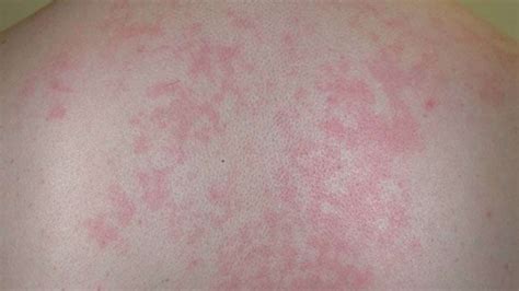 Rash And Fatigue In Adults