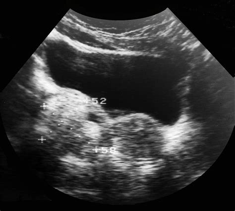 Dermoid Ovarian Cyst Photograph By Zephyrscience Photo Library Fine