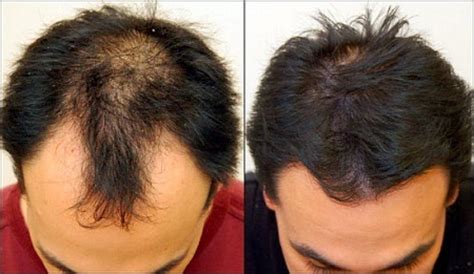 To grow faster hair for men, one needs to regular in diets and not too much of shampoo per day. Treatment for hair grow - Info HealthInfo Health