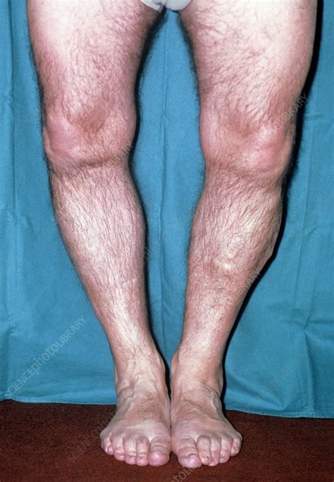 Rickets Vitamin D Deficiency In Man Stock Image M250 0015 Science Photo Library