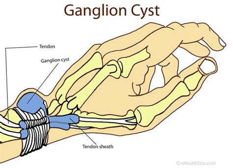 Ganglion Cyst Wrist Knee Foot Ankle Pictures Surgery