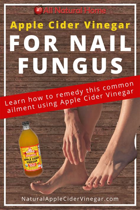 Use This Apple Cider Vinegar For Nail Fungus Home Remedy To Help Remedy