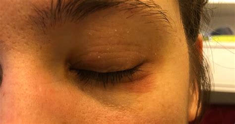 Skin Concerns Dry Eyelids Any Tips Skincareaddiction