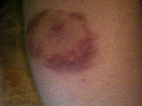 Symptoms and diagnosis | ohio state medical center. Trusting God: bikes, bruises and blood clots