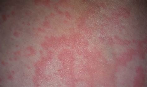 Red Bumpy Rash On Arms Pictures To Pin On Pinterest Pinsdaddy
