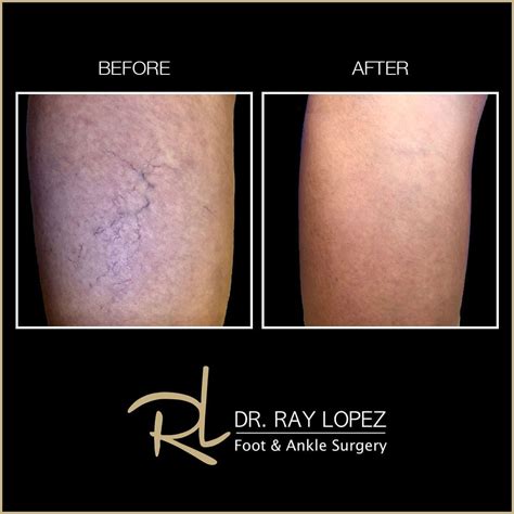 Laser Treatment For Spider Vein Miami Dr Ray Lopez