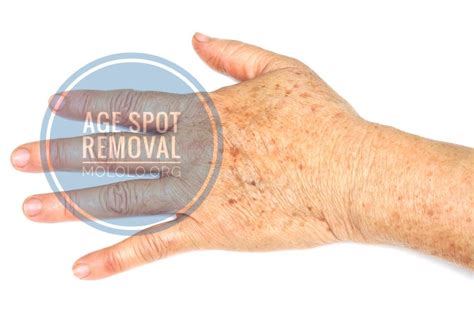 Age Spot Or Liver Spot Or Sunspot Or Solar Keratosis Are Lesions That