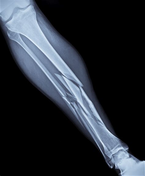 What Is A Fractured Bone Cardiff Physio