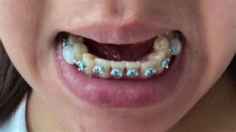 Braces Lower Teeth Crowded Teeth Youtube