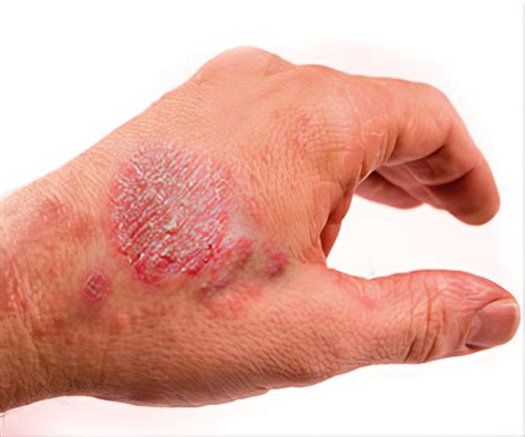Eczema Miracles With Homeopathy