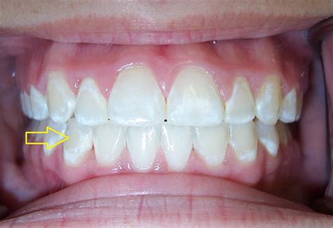 Teeth Treat White Spots On Teeth After Whitening