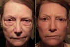 How To Remove Eye Bags Without Surgery - HOWTOREMVO