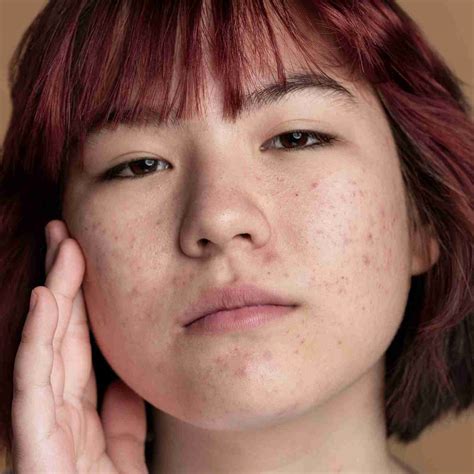 Acne & Blackheads – Beauty by Earth