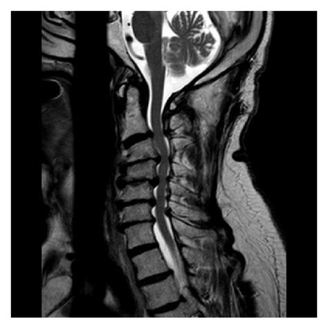 Postoperative T Weighted Sagittal Mri Flexion And Extension Spinal My