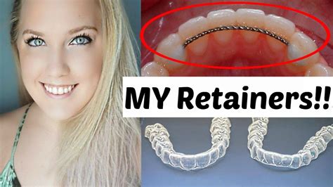 Retainers After Braces Permanent And Temporary Ashley Craig Youtube