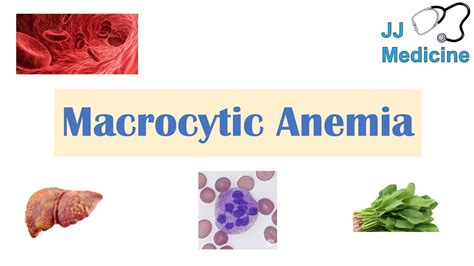 Macrocytic Anemia Megaloblastic Vs Non Megaloblastic Approach