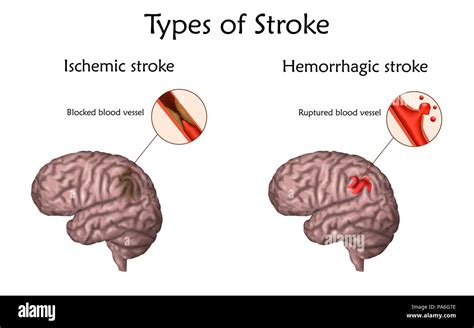 Stroke Types Illustration Blocked Blood Vessel Causing An Ischemic