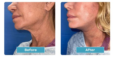 Neck Lift Gallery Newport Beach Cosmetic Surgery And Lipo