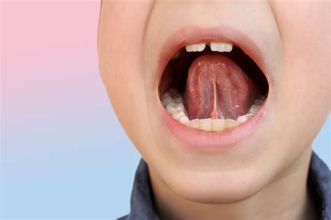 The Potential Exhaustion Of Tongue Tie Symptoms Canada