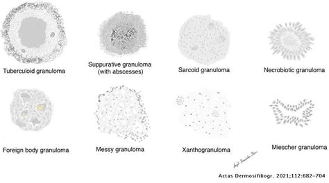 Granulomas In Dermatopathology Principal Diagnoses Part 1 Actas