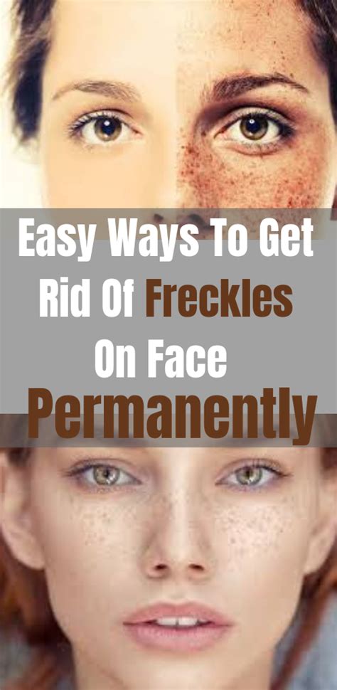 Easy Ways To Get Rid Of Freckles On Face Permanently Getting Rid Of Freckles Freckles Rid