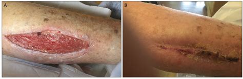 Optimizing Wound Healing For Cosmetic And Medical Dermatologic