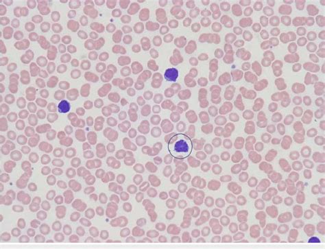 Peripheral Blood Smear 600x Magnification Demonstrating The