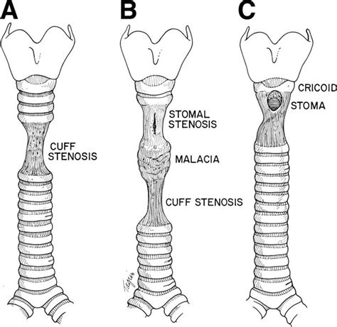 Laryngotracheal Stenosis Idiopathic Subglottic Stenosis Pinterest