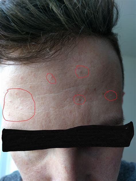 Here's how to identify & treat whiteheads. What are these bumps... closed comedones milia or ...