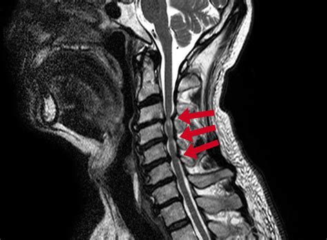Cervical Spinal Stenosis Conditions Dr Schröder